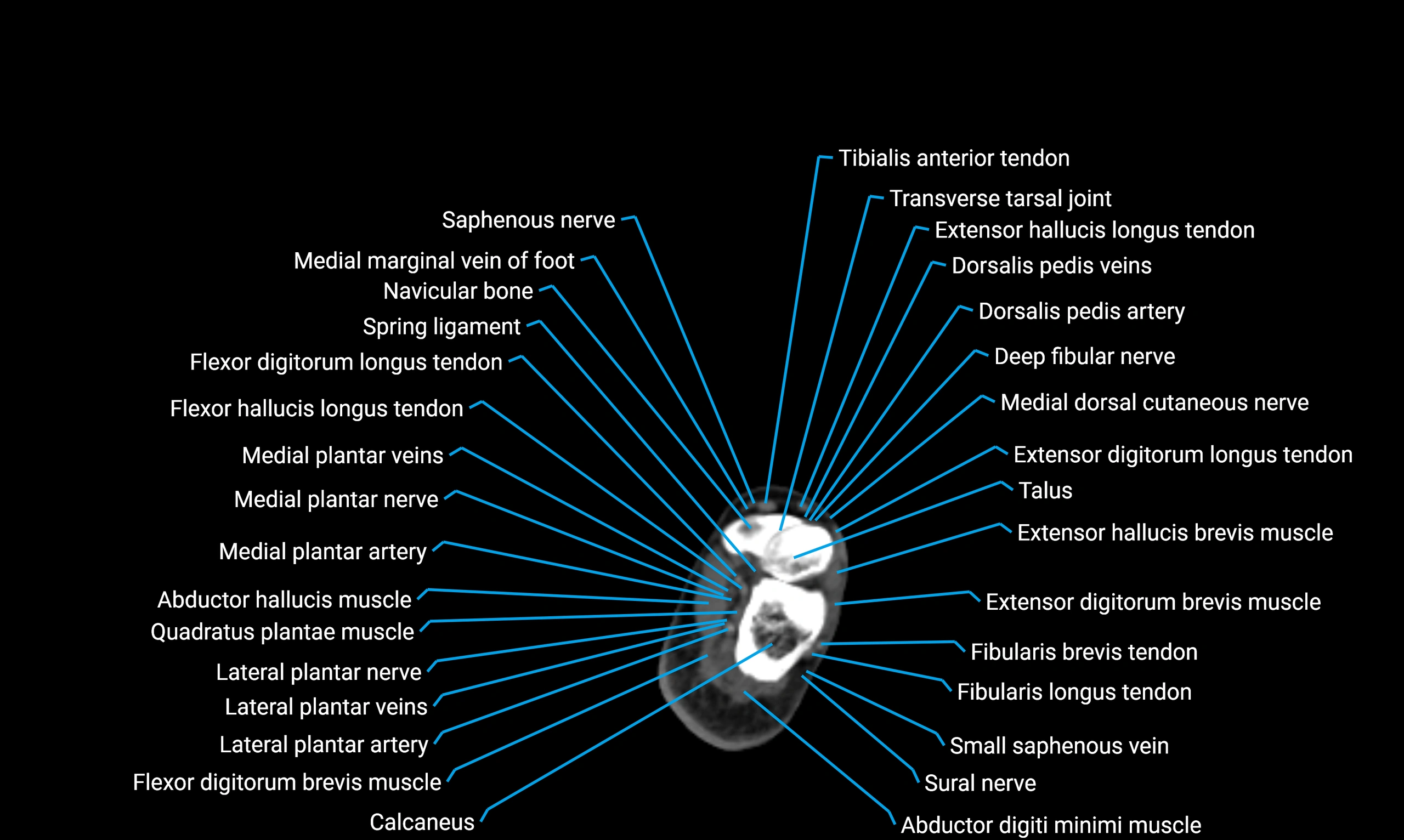 CT lower limb axial cross sectional anatomy labelled image 174 (2).webp